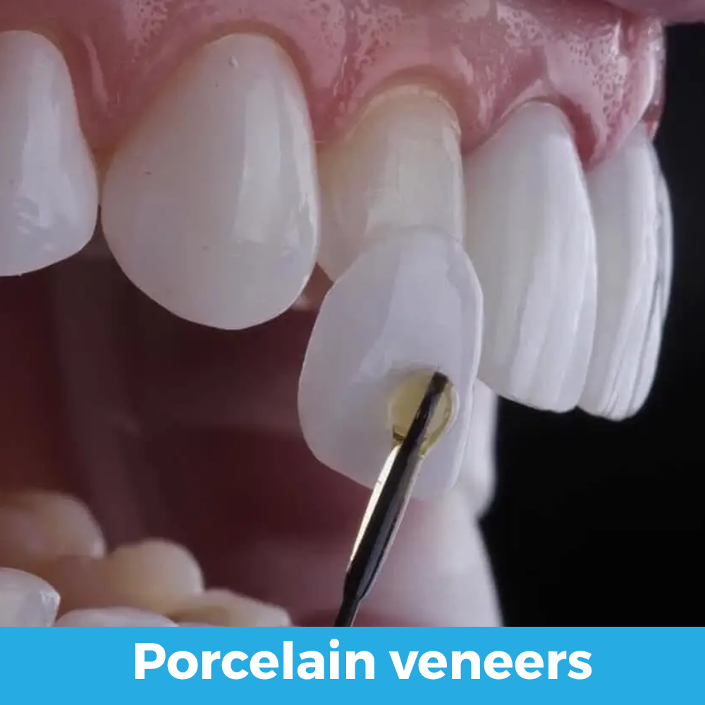 Estética Dental carillas procela 02