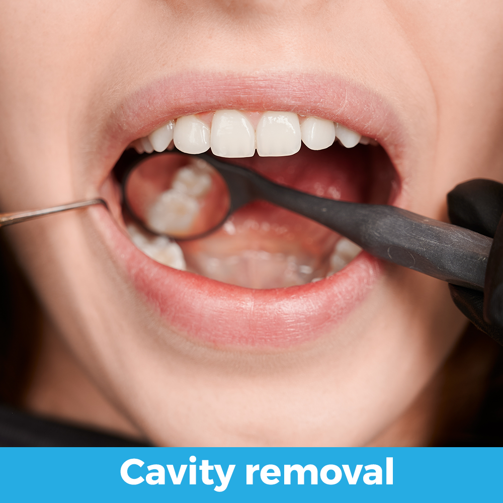 Odontología General cavity removal elimicacion caries ingles