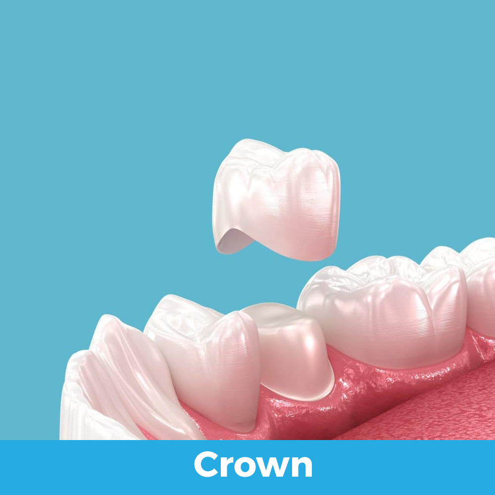 Odontología General crown