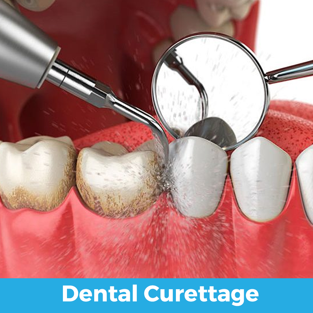 dental curettage 01