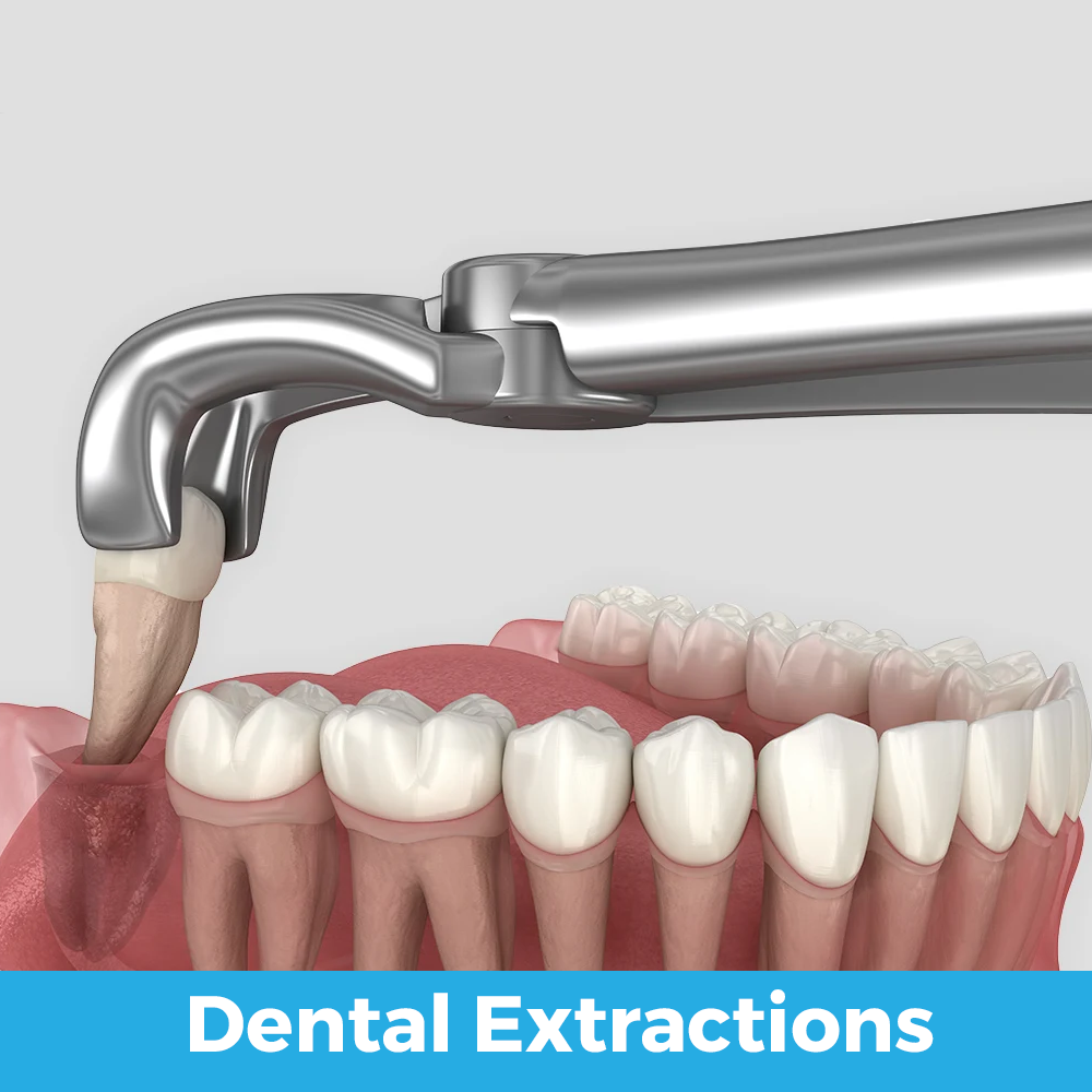 Odontología General dental extractions ingles