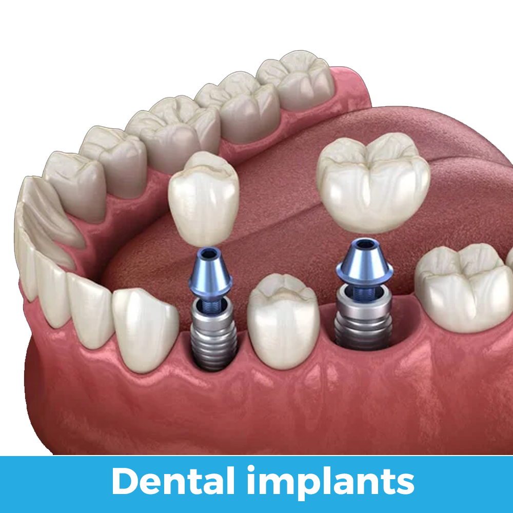 dental implants 01 ingles