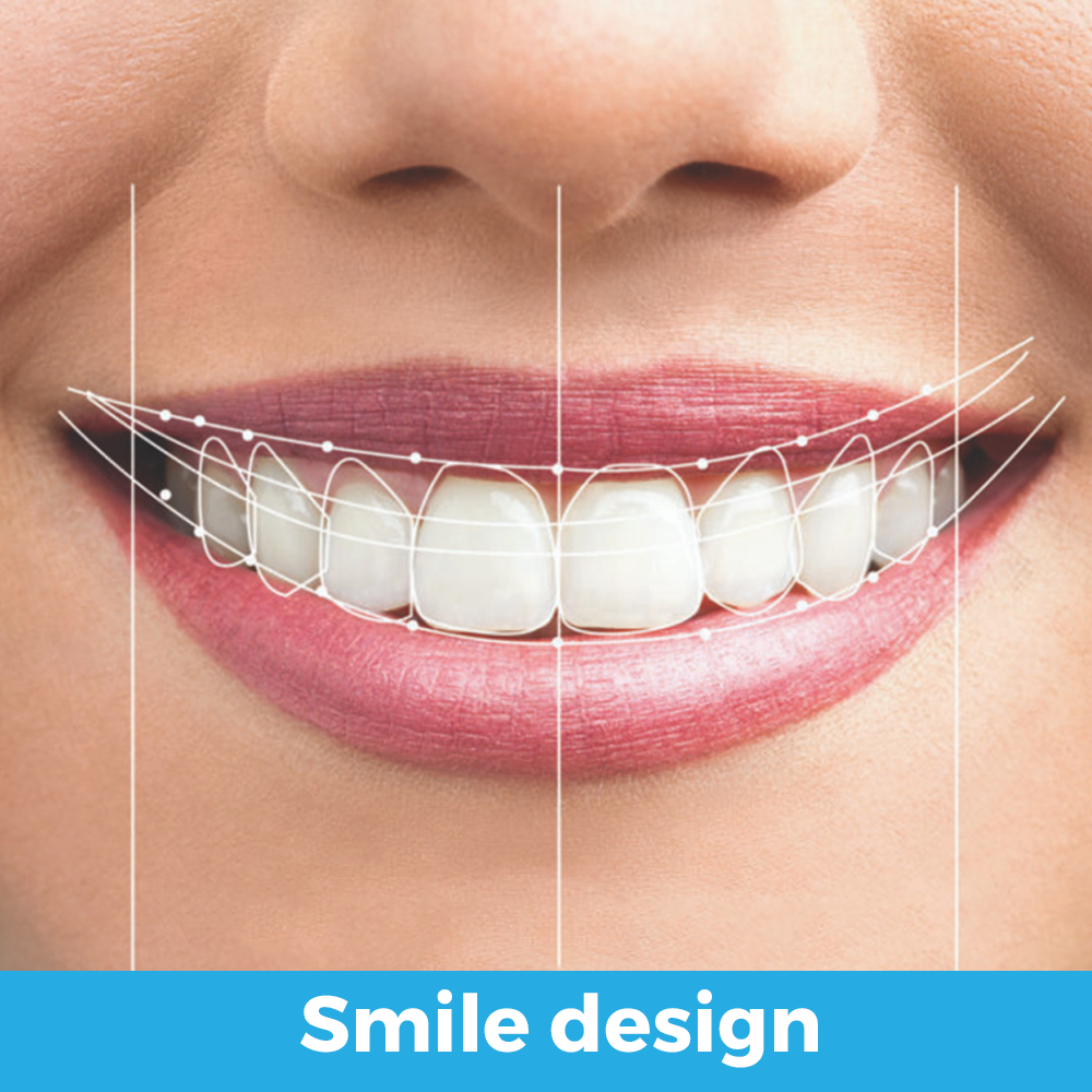 Estética Dental diseño de sonrrisa 01