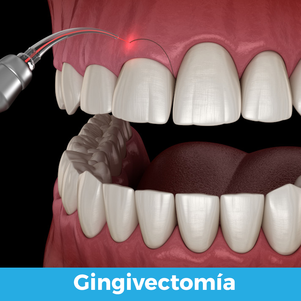 gingivectomía 02