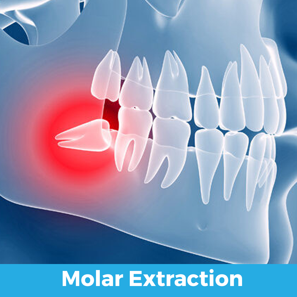 molar extraction 01