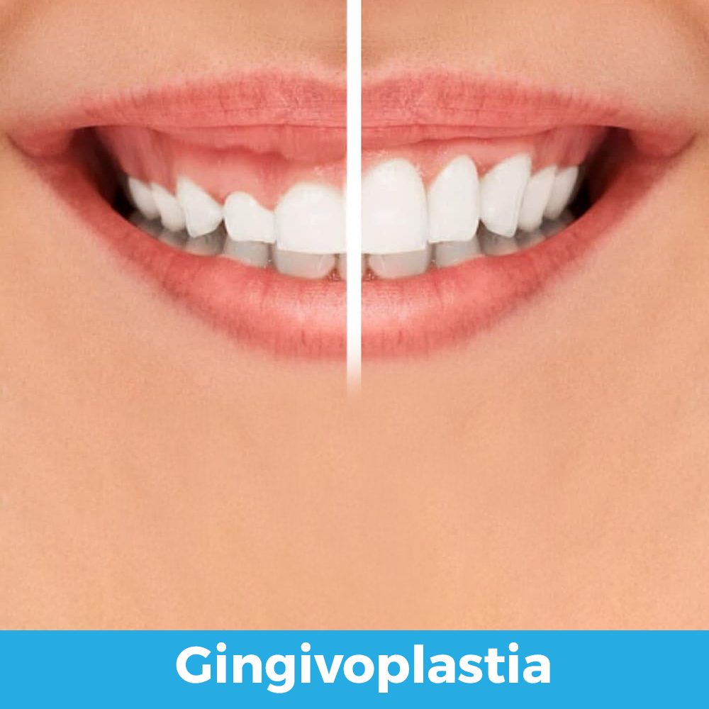 gingivoplastia 03