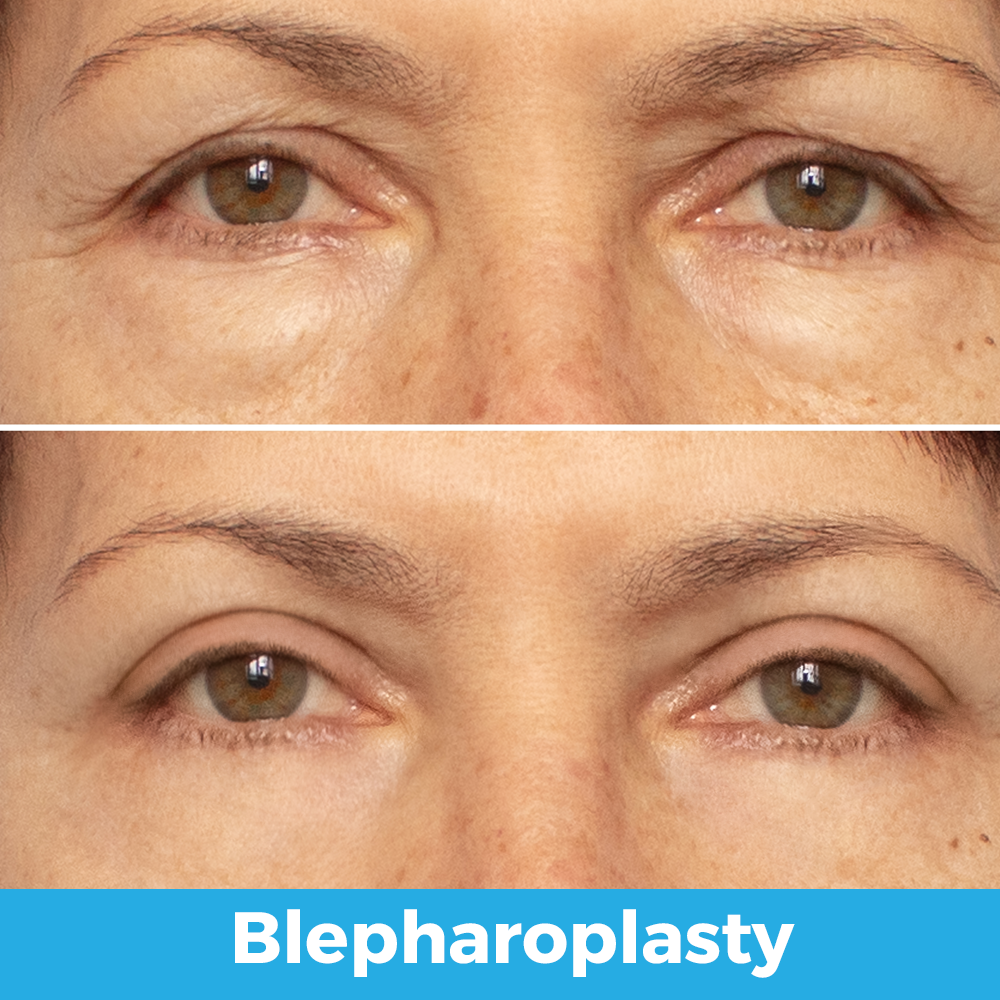 blepharoplasty v2