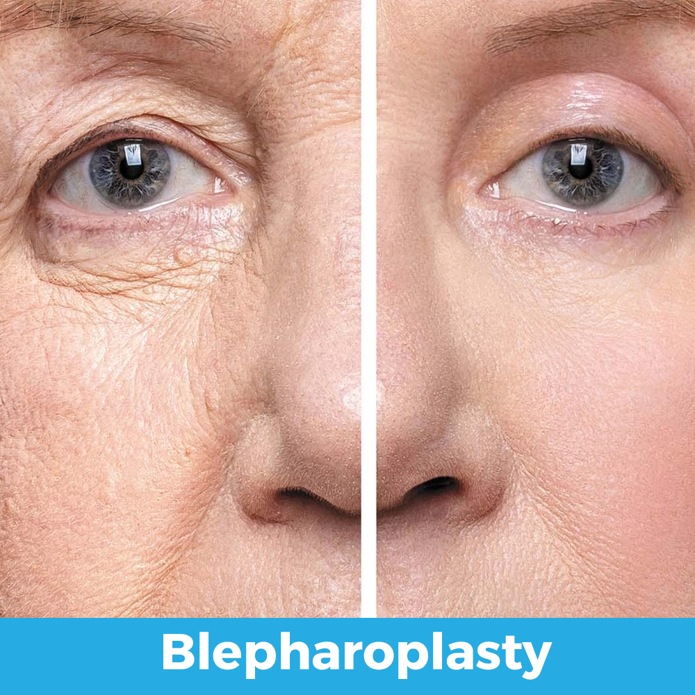 blepharoplasty