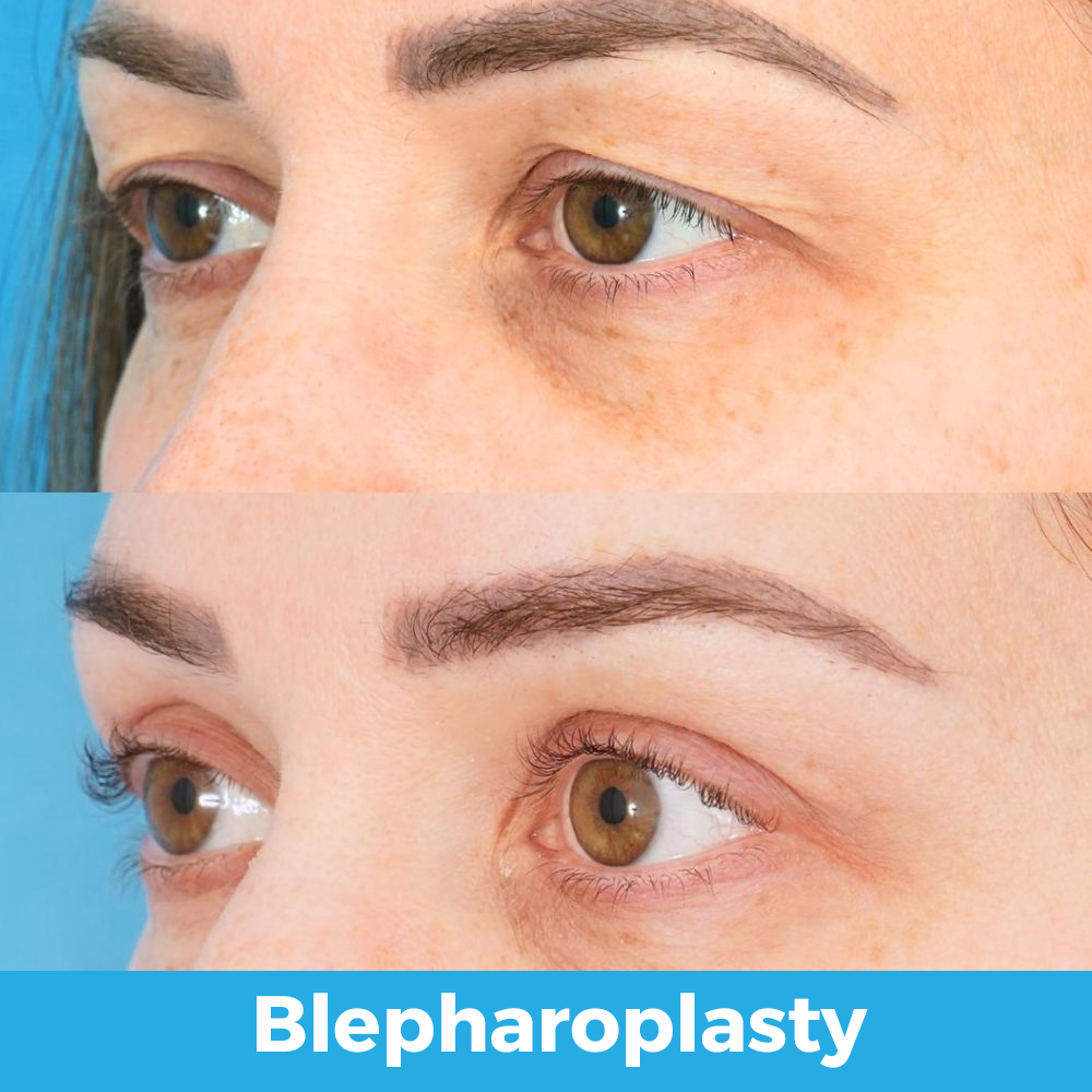 blepharoplastyv3