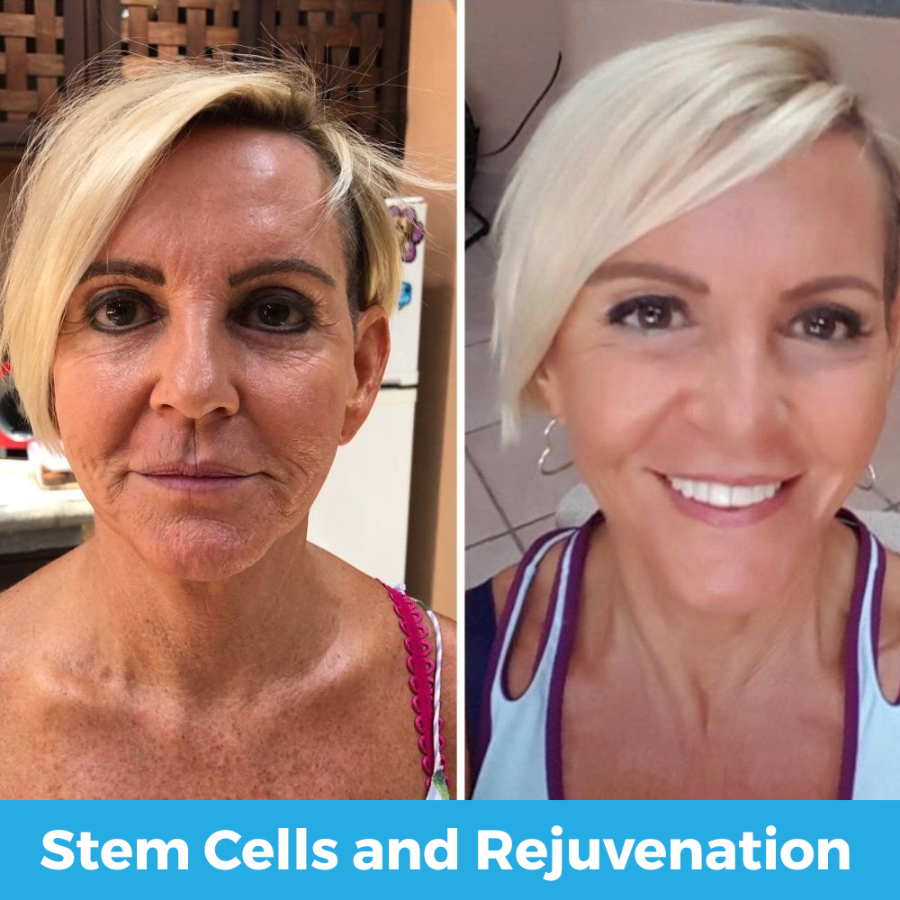 stem cells and rejuvenation
